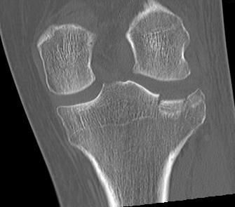 Tibial Plateau Depression